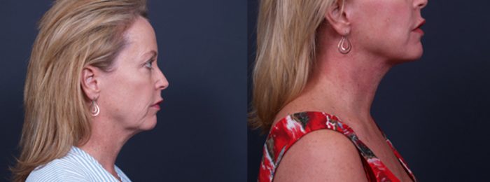 Facelift Patient 13 | Dr. Shaun Parson Plastic Surgery, Scottsdale, Arizona