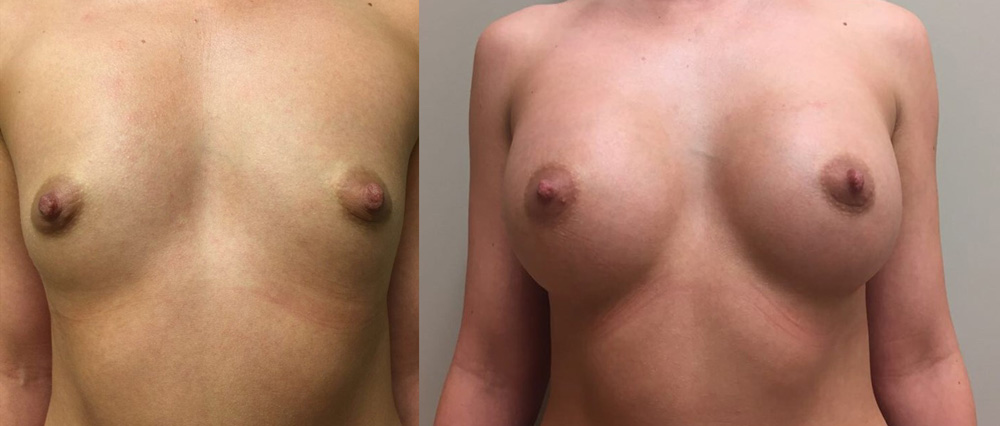 Breast Augmentation Patient 22 | Dr. Shaun Parson Plastic Surgery, Scottsdale, Arizona