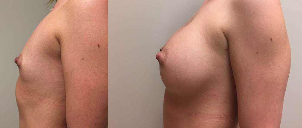 Breast Augmentation Patient 22 | Dr. Shaun Parson Plastic Surgery, Scottsdale, Arizona