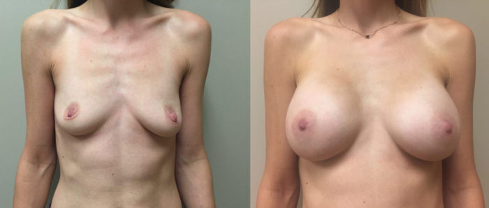 Breast Augmentation Patient 23 | Dr. Shaun Parson Plastic Surgery Scottsdale Arizona