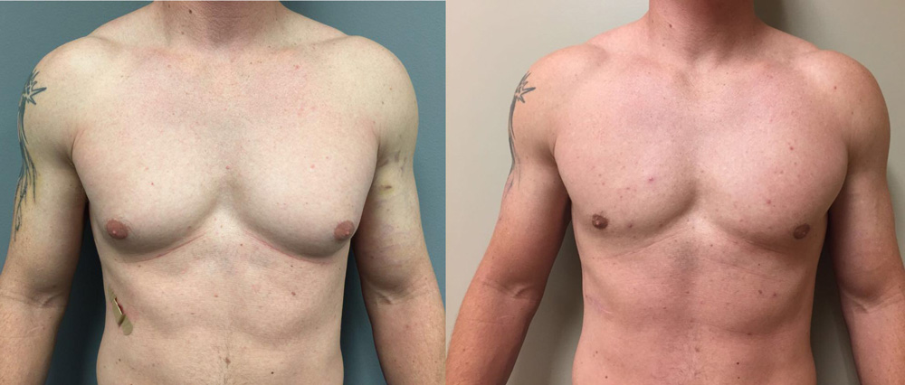 Gynecomastia Patient 8 | Dr. Shaun Parson Plastic Surgery Scottsdale Arizona