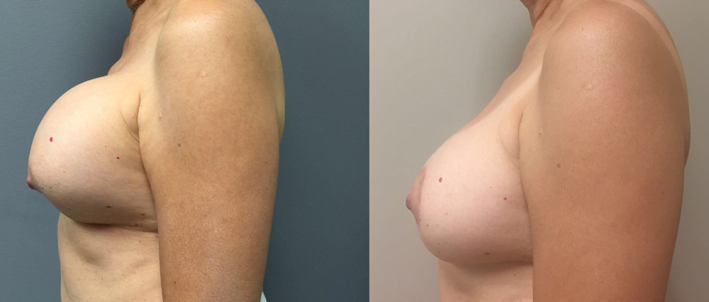 Breast Revision Patient 8 | Dr. Shaun Parson Plastic Surgery, Scottsdale, Arizona