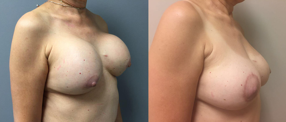 Breast Revision Patient 8 | Dr. Shaun Parson Plastic Surgery, Scottsdale, Arizona