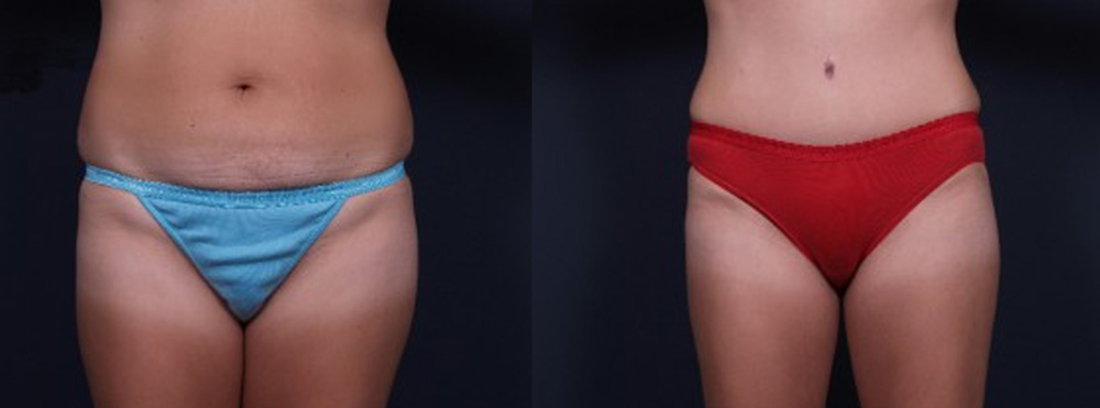 Tummy Tuck Patient 17 | Dr. Shaun Parson Plastic Surgery, Scottsdale, Arizona