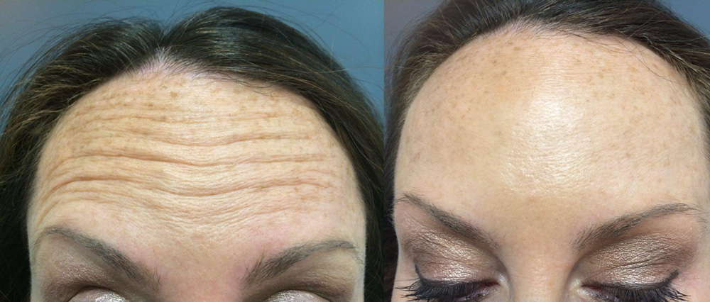 Botox Patient 3 | Dr. Shaun Parson Plastic Surgery Scottsdale Arizona