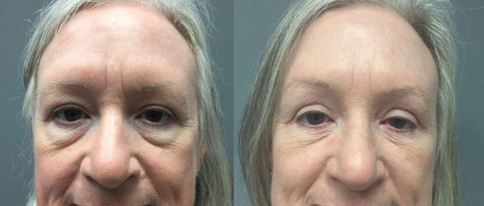 Eyelid Surgery Patient 19 | Dr. Shaun Parson Plastic Surgery, Scottsdale, Arizona