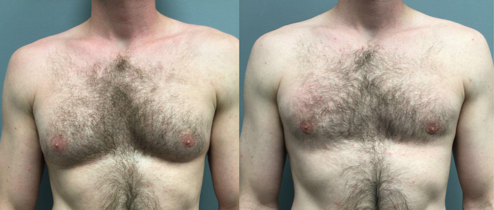 Gynecomastia Patient 10 | Dr. Shaun Parson Plastic Surgery Scottsdale Arizona