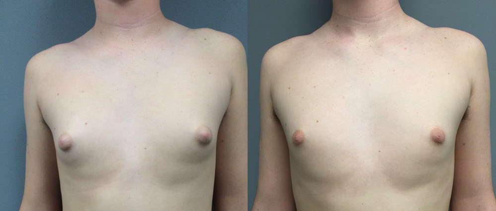 Gynecomastia Patient 9a | Dr. Shaun Parson Plastic Surgery Scottsdale Arizona