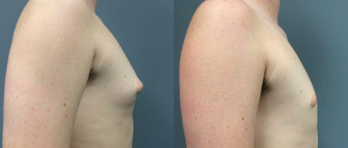 Gynecomastia Patient 9 | Dr. Shaun Parson Plastic Surgery Scottsdale Arizona