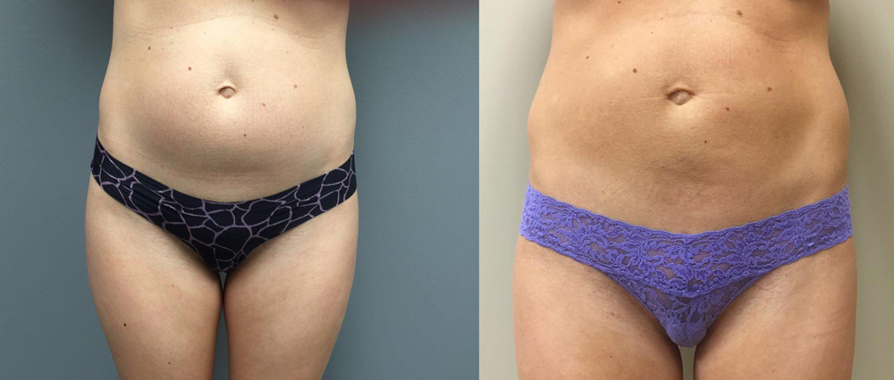 Tummy Tuck Patient 19b | Dr. Shaun Parson Plastic Surgery Scottsdale Arizona