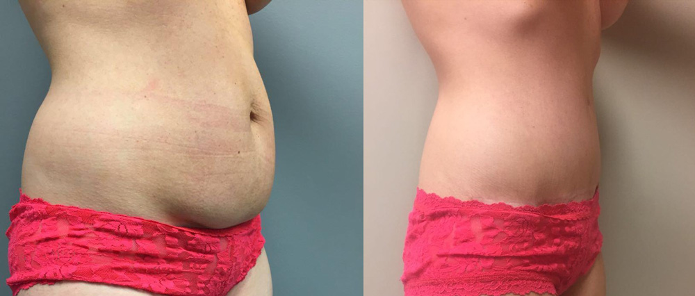 Tummy Tuck Patient 18a | Dr. Shaun Parson Plastic Surgery Scottsdale Arizona