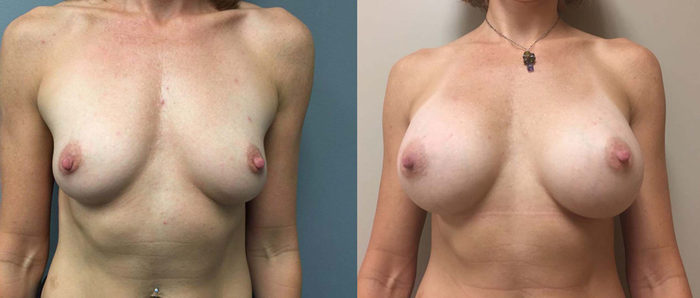 Breast Augmentation Patient 27b | Dr. Shaun Parson Plastic Surgery Scottsdale Arizona