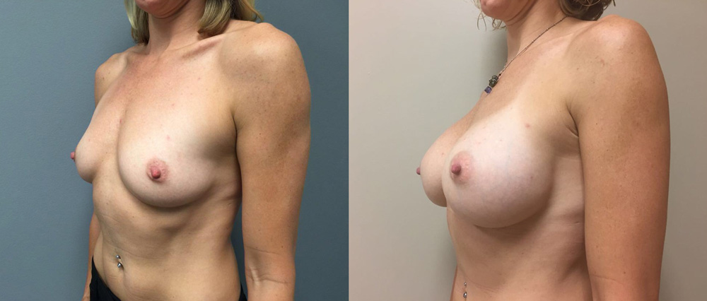 Breast Augmentation Patient 27a | Dr. Shaun Parson Plastic Surgery Scottsdale Arizona