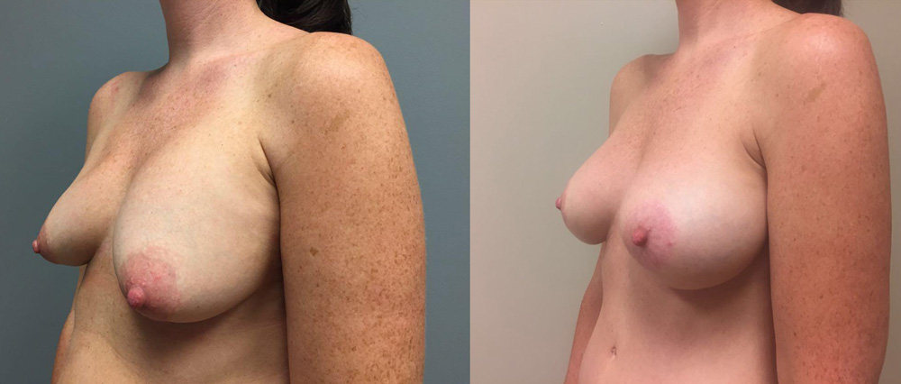 Breast Lift Peri Aug Patient 31b | Dr. Shaun Parson Plastic Surgery Scottsdale Arizona