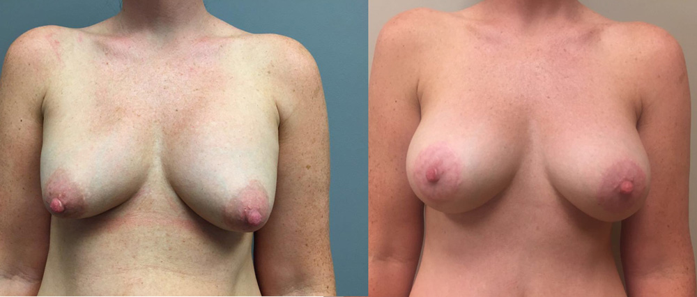 Breast Lift Peri Aug Patient 31a | Dr. Shaun Parson Plastic Surgery Scottsdale Arizona