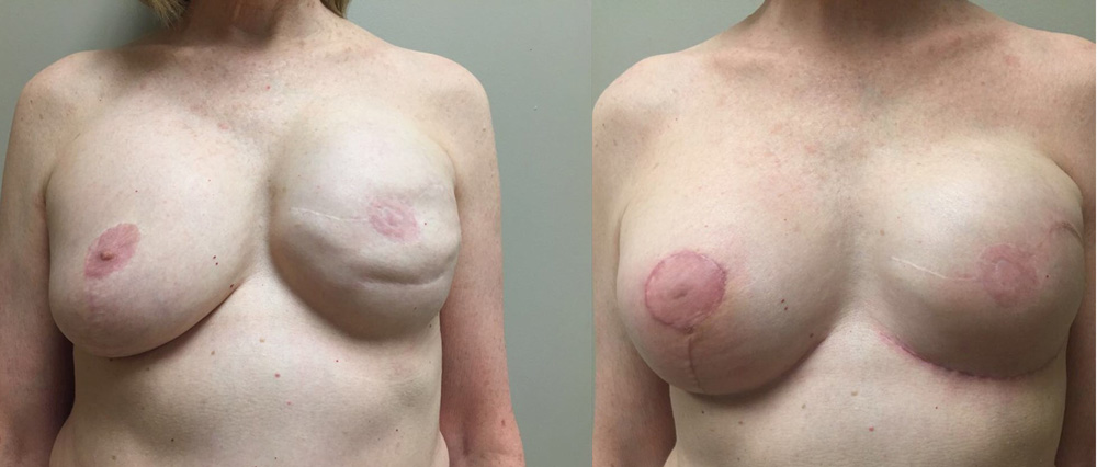 Breast Revision Patient 8a | Dr. Shaun Parson Plastic Surgery, Scottsdale, Arizona