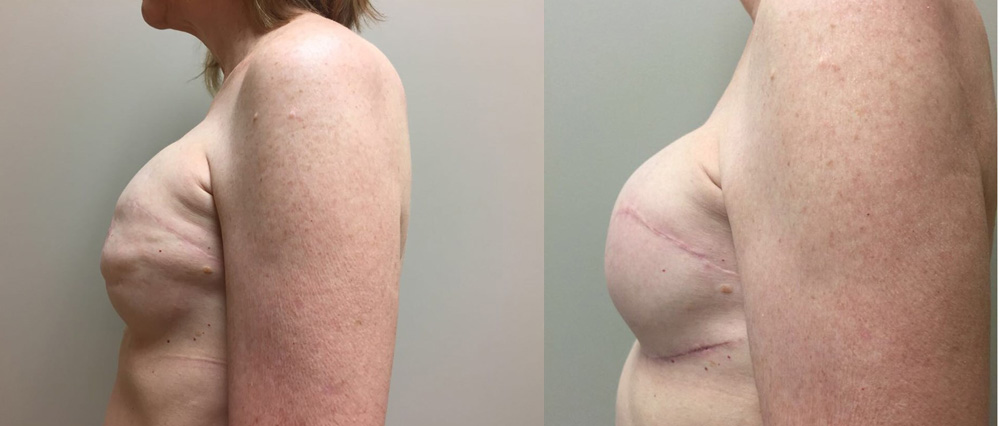 Breast Revision Patient 8a | Dr. Shaun Parson Plastic Surgery, Scottsdale, Arizona