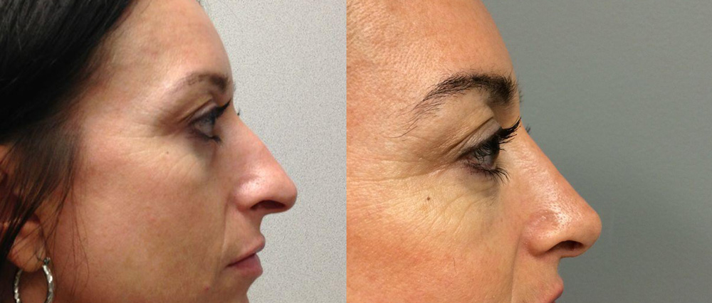 Rhinoplasty Patient 7 | Dr. Shaun Parson Plastic Surgery, Scottsdale, Arizona