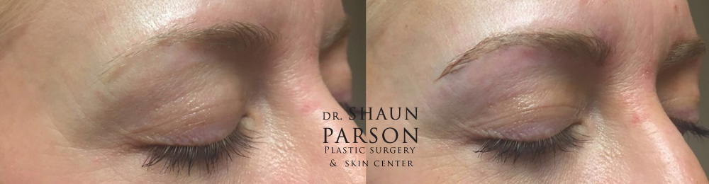 Microblading Patient 1 | Dr. Shaun Parson Plastic Surgery Scottsdale Arizona