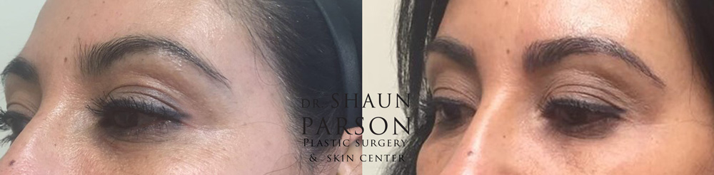 Microblading Patient 3 | Dr. Shaun Parson Plastic Surgery Scottsdale Arizona