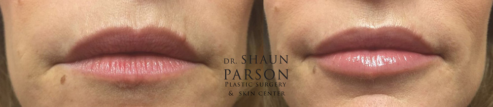 Dermal Filler Patient 5 | Dr. Shaun Parson Plastic Surgery Scottsdale Arizona