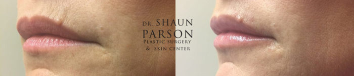 Dermal Filler Patient 5b | Dr. Shaun Parson Plastic Surgery Scottsdale Arizona