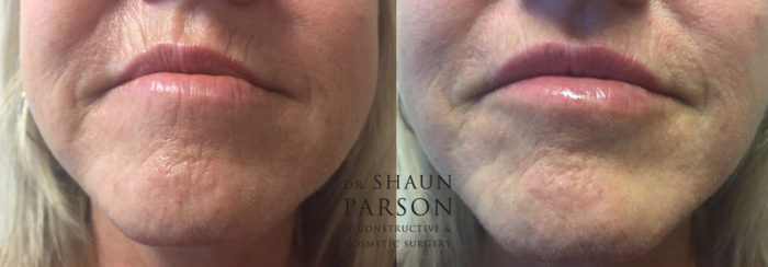 Dermal Filler Patient 4 | Dr. Shaun Parson Plastic Surgery Scottsdale Arizona