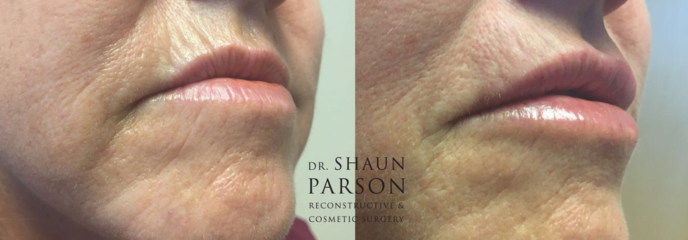 Dermal Filler Patient 4b | Dr. Shaun Parson Plastic Surgery Scottsdale Arizona