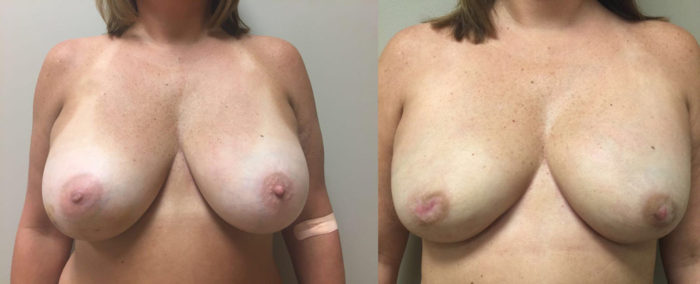 Breast Reconstruction Patient 14 | Dr. Shaun Parson Plastic Surgery Scottsdale Arizona