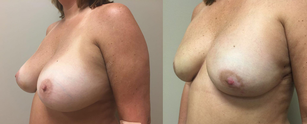 Breast Reconstruction Patient 14 | Dr. Shaun Parson Plastic Surgery Scottsdale Arizona