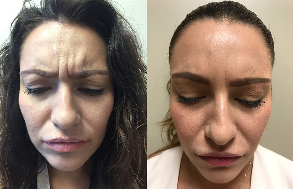 Botox Patient 4 | Dr. Shaun Parson Plastic Surgery Scottsdale Arizona