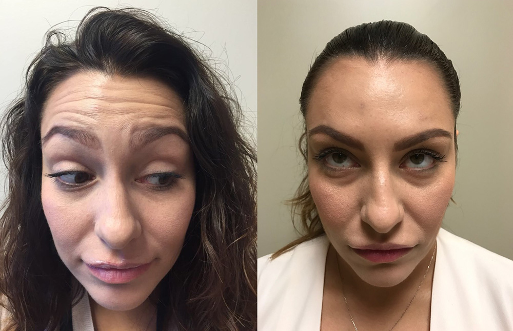 Botox Patient 4 | Dr. Shaun Parson Plastic Surgery Scottsdale Arizona