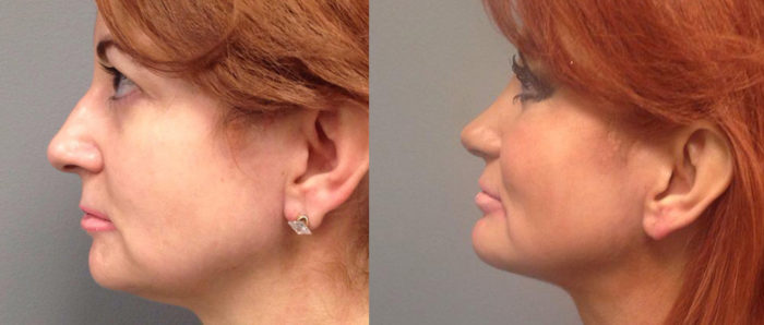 Rhinoplasty Patient 8 | Dr. Shaun Parson Plastic Surgery Scottsdale Arizona