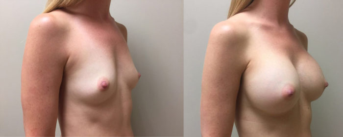 Breast Augmentation Patient 28 | Dr. Shaun Parson Plastic Surgery, Scottsdale, Arizona