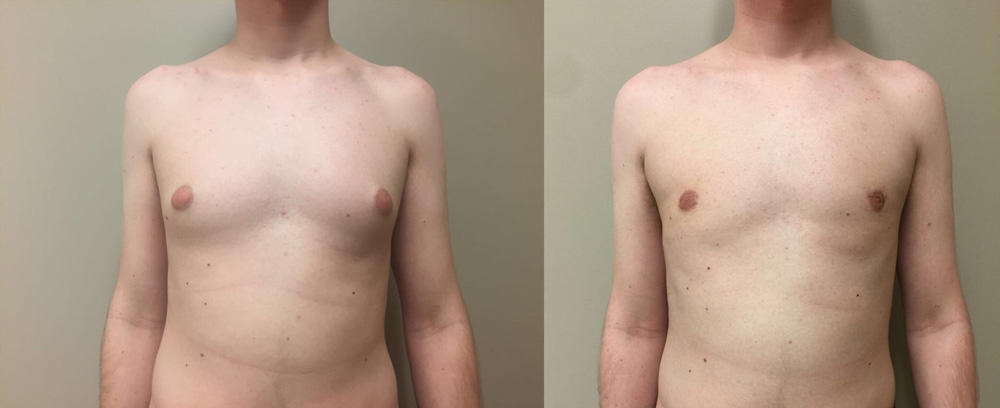 Gynecomastia Patient 11 | Dr. Shaun Parson Plastic Surgery Scottsdale Arizona