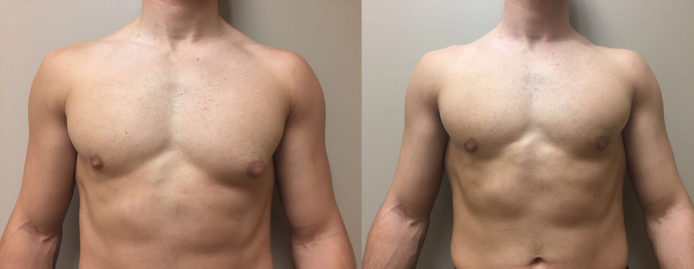 Gynecomastia Patient 12 | Dr. Shaun Parson Plastic Surgery Scottsdale Arizona