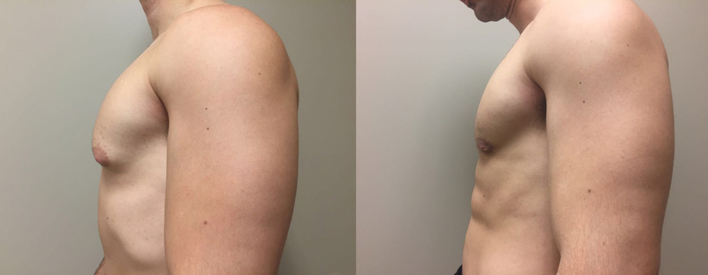 Gynecomastia Patient 12 | Dr. Shaun Parson Plastic Surgery Scottsdale Arizona