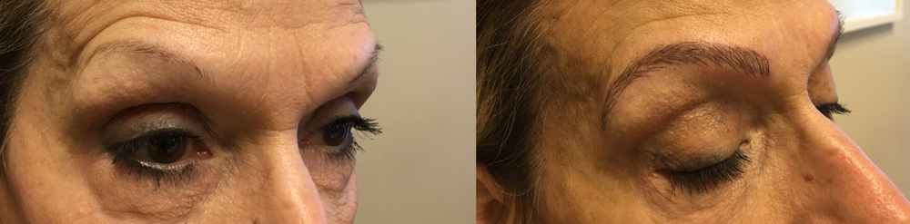 Microblading Patient 3 | Dr. Shaun Parson Plastic Surgery Scottsdale Arizona