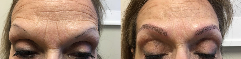 Microblading Patient 4 | Dr. Shaun Parson Plastic Surgery Scottsdale Arizona