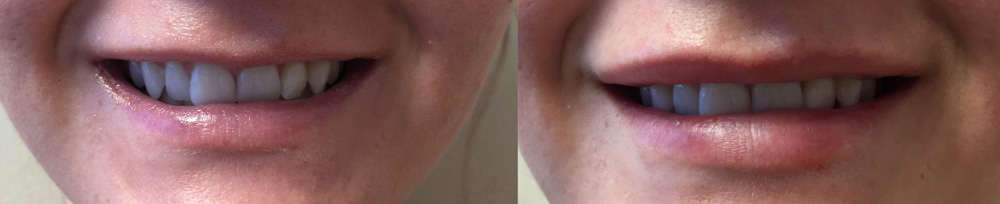 Dermal Fillers Patient 6