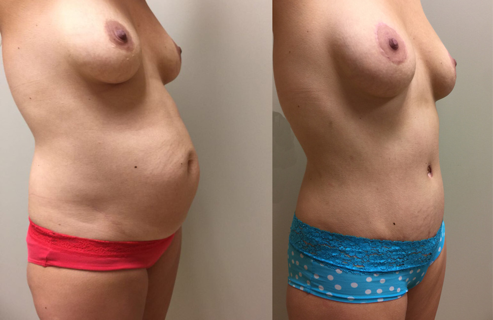 Tummy Tuck Patient 23 | Dr. Shaun Parson Plastic Surgery Scottsdale Arizona