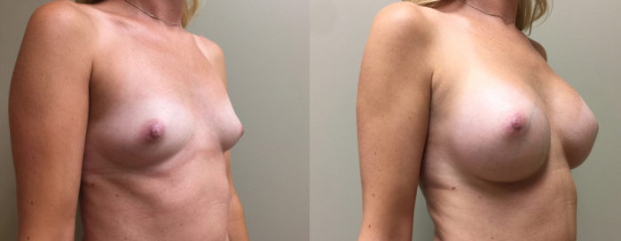 Breast Augmentation Patient 30 | Dr. Shaun Parson Plastic Surgery, Scottsdale, Arizona