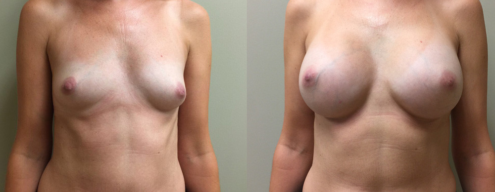 Breast Augmentation Patient 30 | Dr. Shaun Parson Plastic Surgery, Scottsdale, Arizona