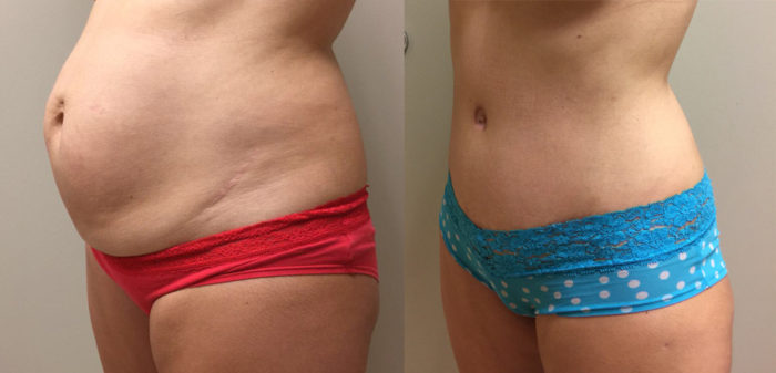 Tummy Tuck Patient 23 | Dr. Shaun Parson Plastic Surgery Scottsdale Arizona