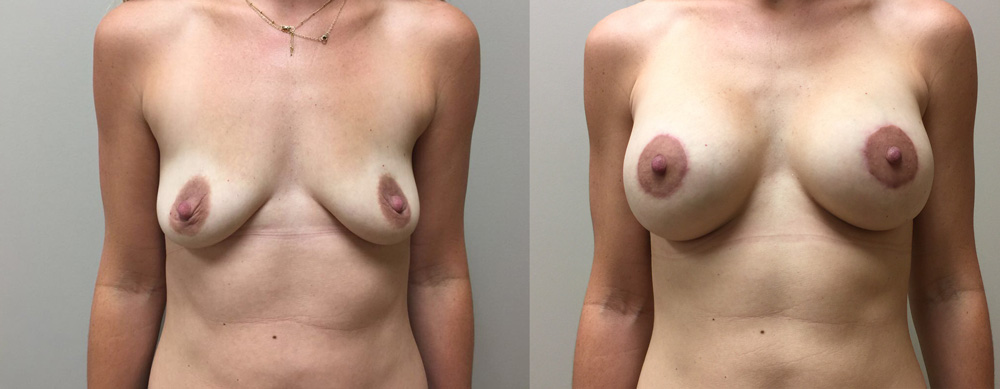 Breast Lift Peri Aug Patient 32 | Dr. Shaun Parson Plastic Surgery Scottsdale Arizona