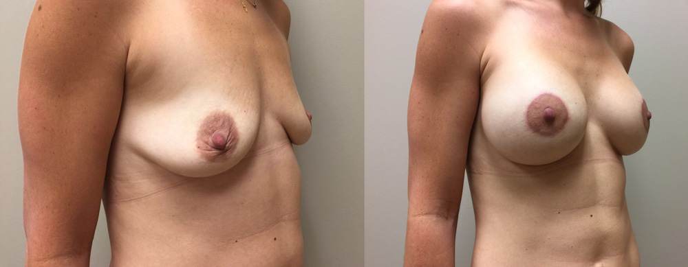 Breast Lift Peri Aug Patient 32 | Dr. Shaun Parson Plastic Surgery Scottsdale Arizona