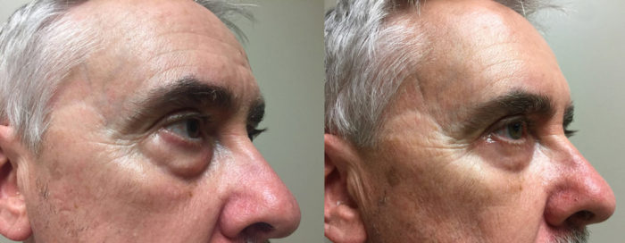 Eyelid Surgery Patient 20 | Dr. Shaun Parson Plastic Surgery, Scottsdale, Arizona