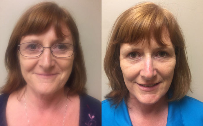 Facelift Patient 17 | Dr. Shaun Parson Plastic Surgery Scottsdale Arizona