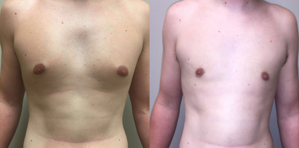 Gynecomastia Patient 13 | Dr. Shaun Parson Plastic Surgery Scottsdale Arizona