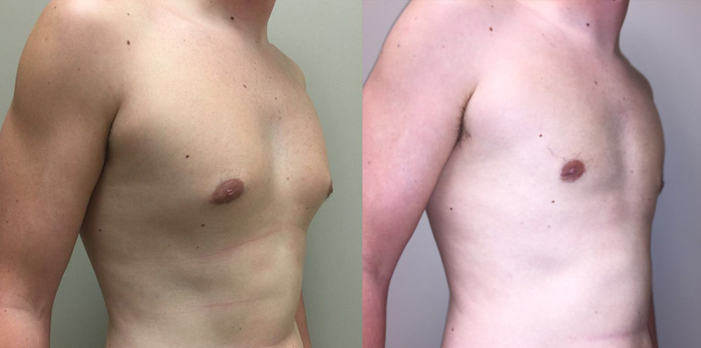 Gynecomastia Patient 13 | Dr. Shaun Parson Plastic Surgery Scottsdale Arizona